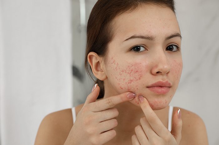 Panduan Lengkap Urutan Skincare untuk Kulit Berminyak dan Berjerawat