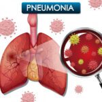 Pneumonia/agm medica