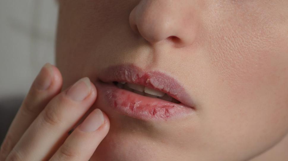 Tips Ampuh Mengatasi Bibir Pecah-pecah dan Kering/Suara.com