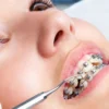 Biar Tidak Menyeseal Sering Sering Konsultasi kan ke Dokter karena Pemakaian Kawat Gigi Bisa Menimbulkan Bahaya Kesehatan.