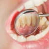Jaga dan Hindari Karang Gigi yang Berlebih Sehingga tidak Menimbulkan Efek Samping pada Kesehatan Gigi Kita !